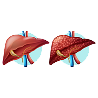 Liver Cancer