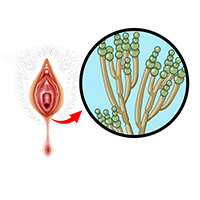 Soft Tissue Tumour